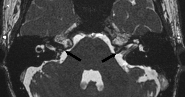 internal auditory canal ct