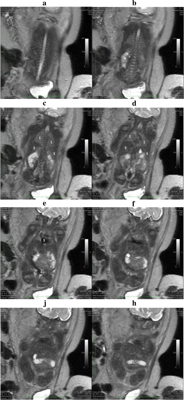 MRI confirming renal agenesis.jpg
