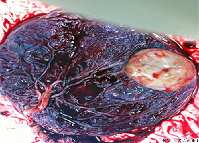 File:Placental chorioangioma 01.jpg
