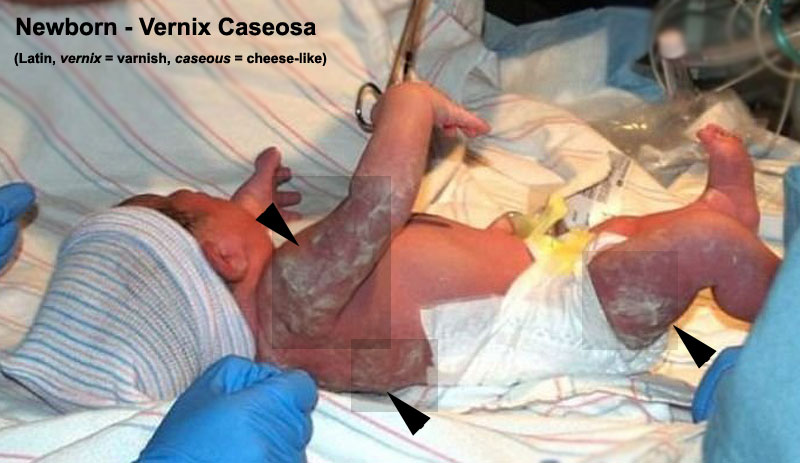 File:Newborn - vernix caseosa.jpg