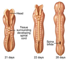 File:Spina-bifida-lg-enlg - embryo.jpg