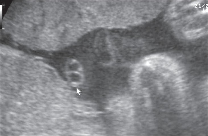 File:Placental cord ultrasound 02.jpg