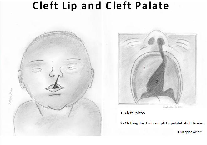 Cleft palate and lip