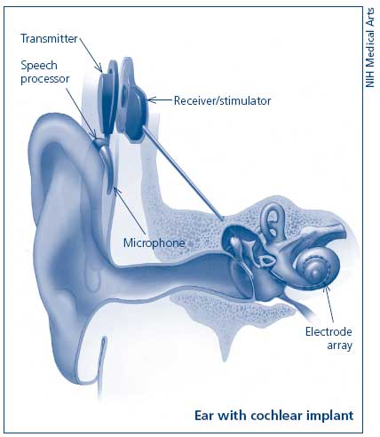 File:Cochlear Implant.jpg