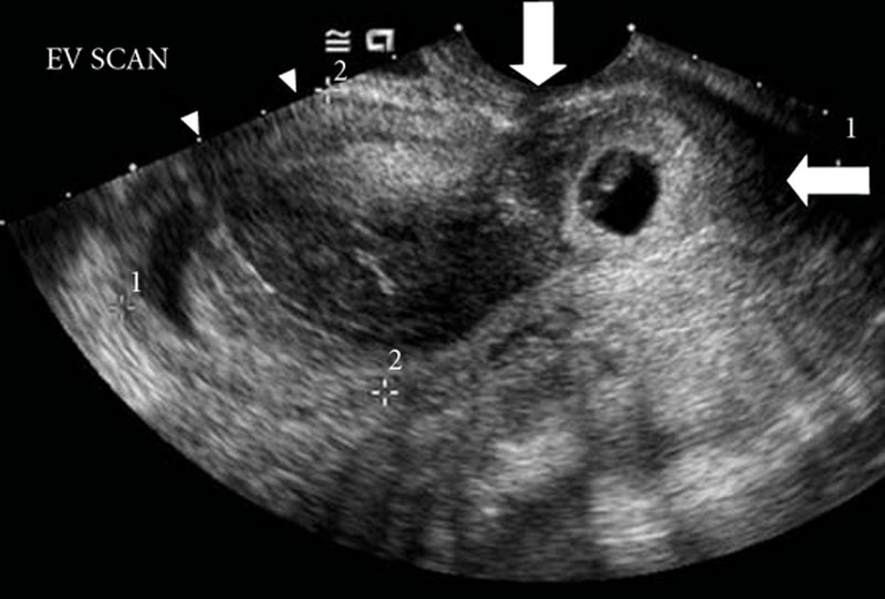 File:Cervical ectopic ultrasound.jpg