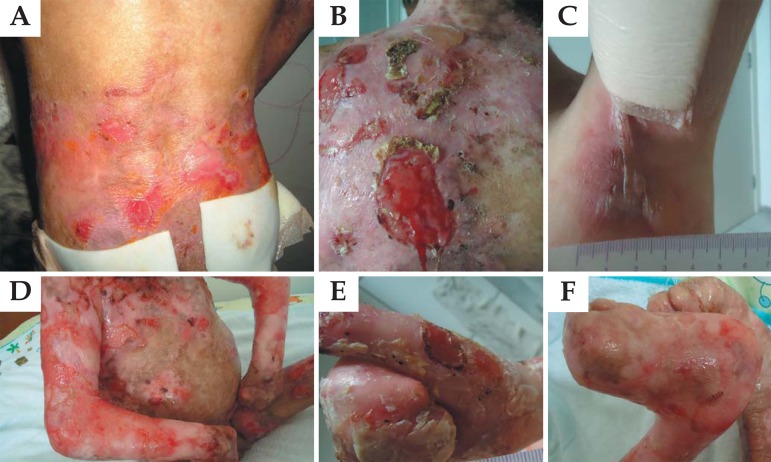 File:Dystrophic Epidermolysis Bullosa lesions.jpg