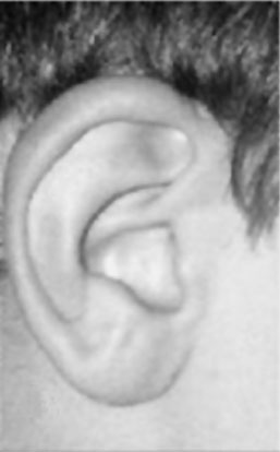 File:Beckwith-Wiedemann syndrome ear lobe creases.jpg