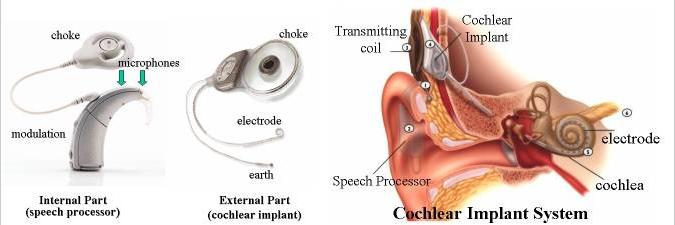 File:Cochlear implant.JPG