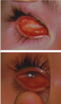 File:Clinical appearance of anophthalmia and microphthalmia.png