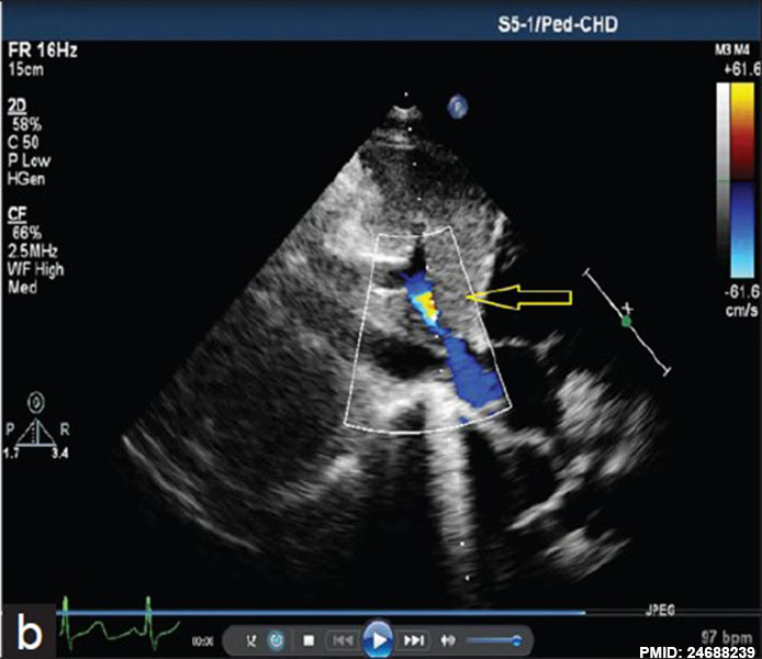File:Postnatal persistant ductus venosus ultrasound 03.jpg