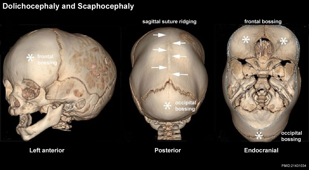 Dolichocephaly and Scaphocephaly