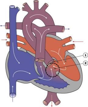 File:Double Outlet Right Ventricle.jpg