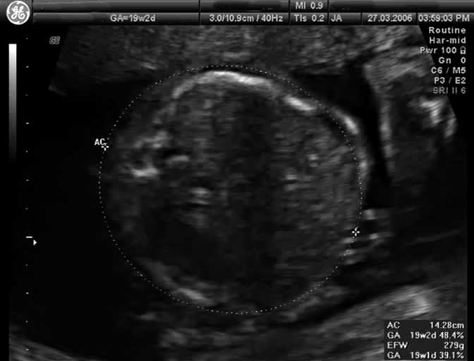 File:Ultrasound - fetal abdominal circumference.jpg