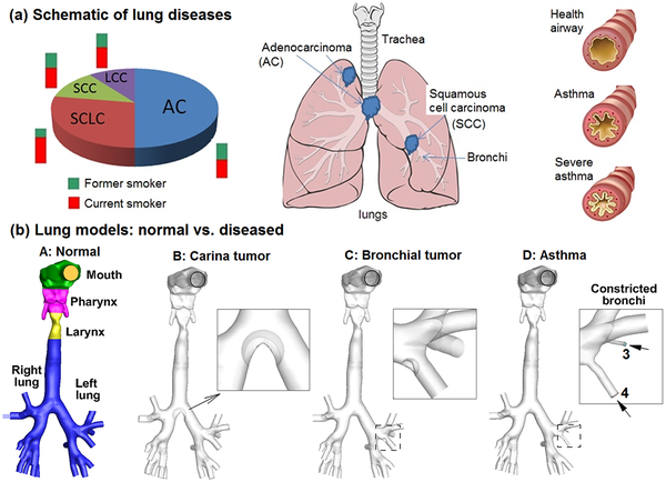 File:Lung Models Normal vs. Diseased.png