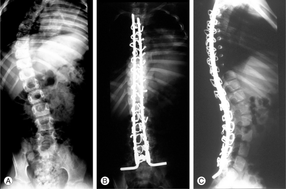 Surgical correction of a 11-year old patient suffering from Duchenne muscular dystrophy.jpg