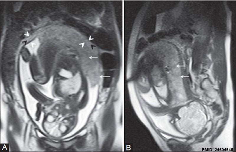 Placenta MRI 01.jpg
