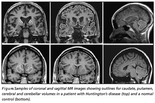 Huntington Disease patient and control MRI.gif