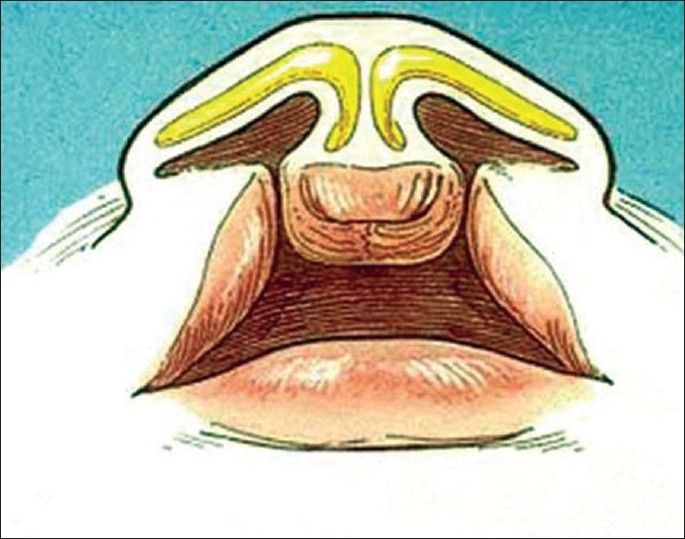 File:Bilateral Cleft Lip With Nasal Deformity.jpg