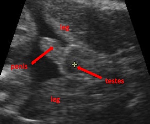 File:Ultrasound male.jpg