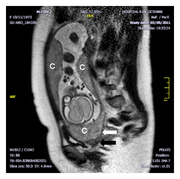 File:Multilobed placenta MRI01.jpg