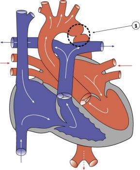 File:Coarctation of the Aorta.jpg