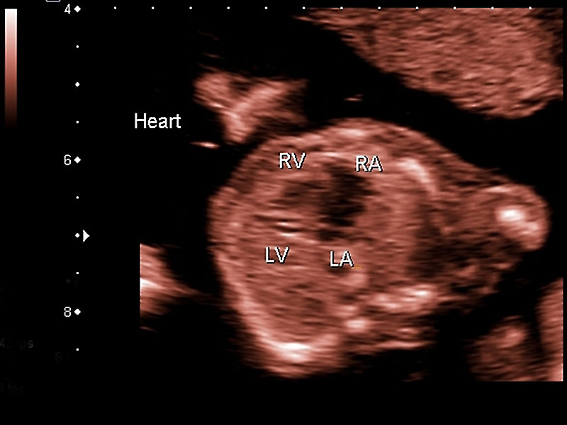 File:Ultrasound - Hypoplastic left heart syndrome 01.jpg