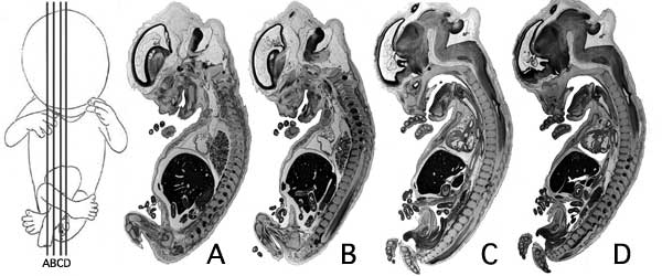 Human- fetal week 10 sagittal planes.jpg
