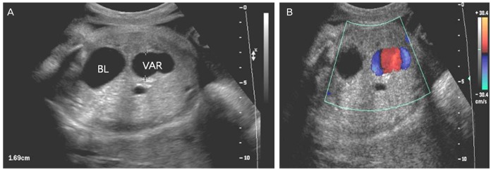 File:Fetal intra-abdominal umbilical vein varix ultrasound 01.jpg