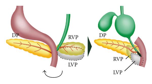 File:Development of the pancreas during fetal development.jpg