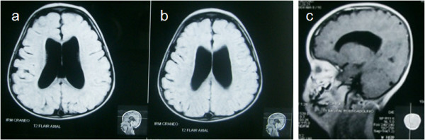 File:Magnetic Resonance of Head MRI from patient with Down Syndrome and Klinefelter's Syndrome.jpg