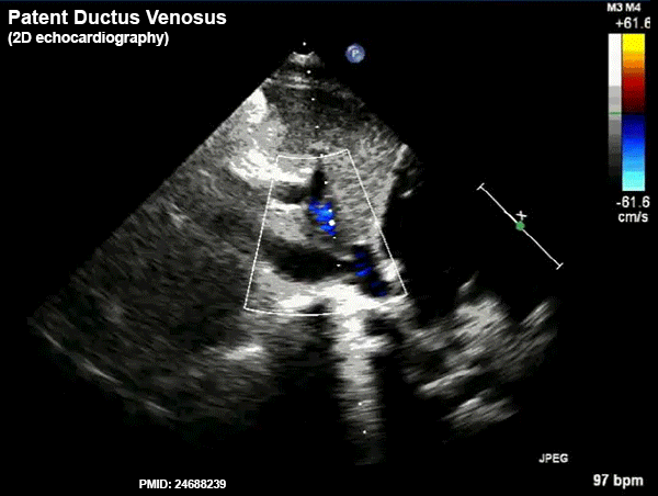 File:Patent ductus venosus ultrasound 01.gif