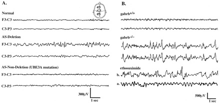 File:Electroencephalography of Angelman Syndrome.jpg