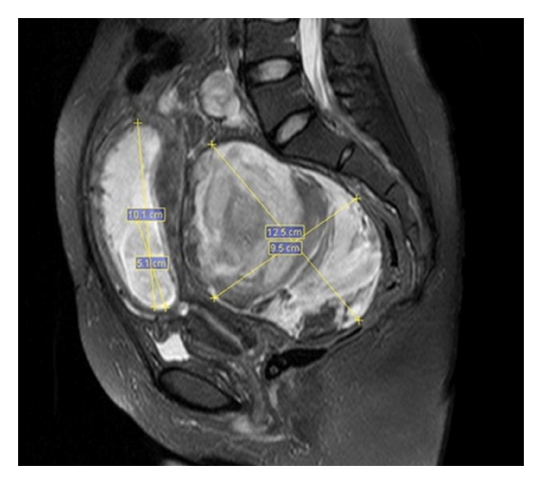 File:Heterotopic pregnancy MRI 01.jpg