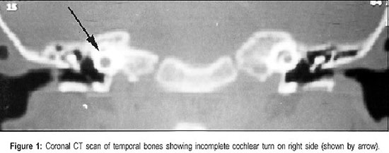 File:Incomplete cochlea CT.jpg