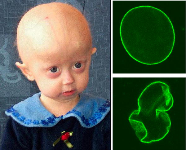 File:Hutchinson-Gilford Progeria Syndrome.jpg