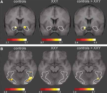 File:FMRI Images of Brain Activation in XXY Patients.JPG