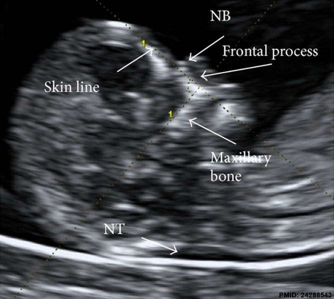 File:Ultrasound nuchal translucency.jpg