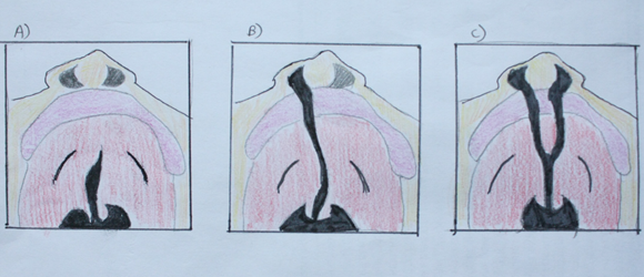 File:Different forms of cleft palate.png