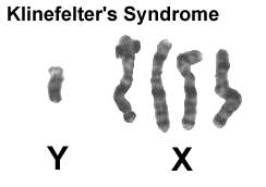 File:Klinefelter syndrome YXXXX.jpg