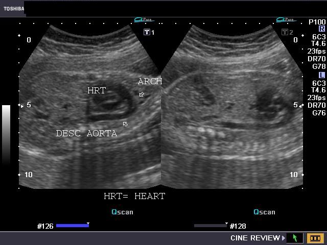 ZUltrasound Image of Fetal Aorta.jpg
