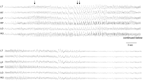 File:EEG in Angelman syndrome mice with a maternal deletion from Ube3a to Gabrb3.jpg