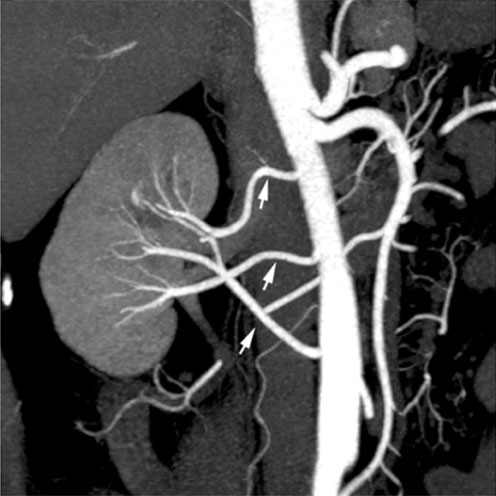 File:Multiple renal arteries 01.jpg