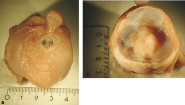 Human holoprosencephaly dissection
