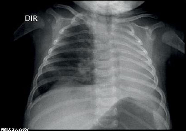 File:Agenesis of left lung.jpg