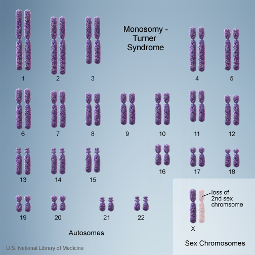 File:Chromosome- monosomy.jpg