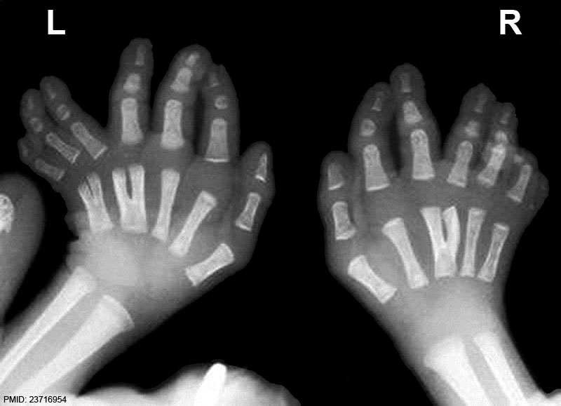 File:Polydactyly and y-shaped central metacarpals x-ray.jpg