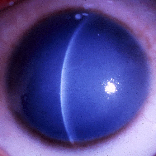 File:Appearance of cornea due to CHED.jpeg