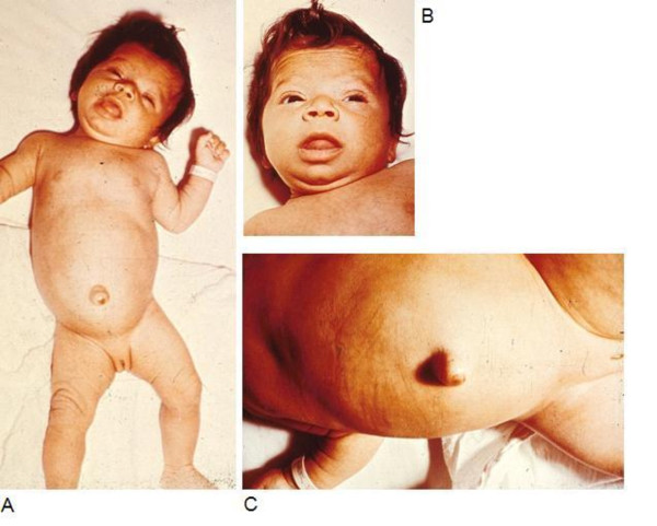 File:Infant with congenital hypothyroidism.jpg