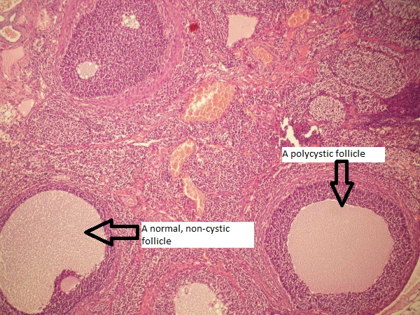 File:Polycystic rat ovary.jpg