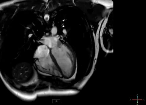 File:MRI heart.JPG